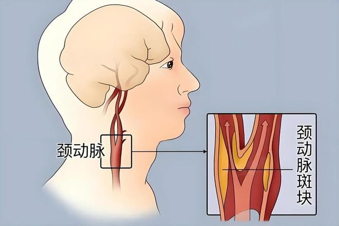  从颈动脉斑块70%狭窄到指标正常：燕麦β-葡聚糖的代谢调控机制深度解析 健康养生